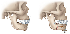 Orthognathic surgery for receding chin